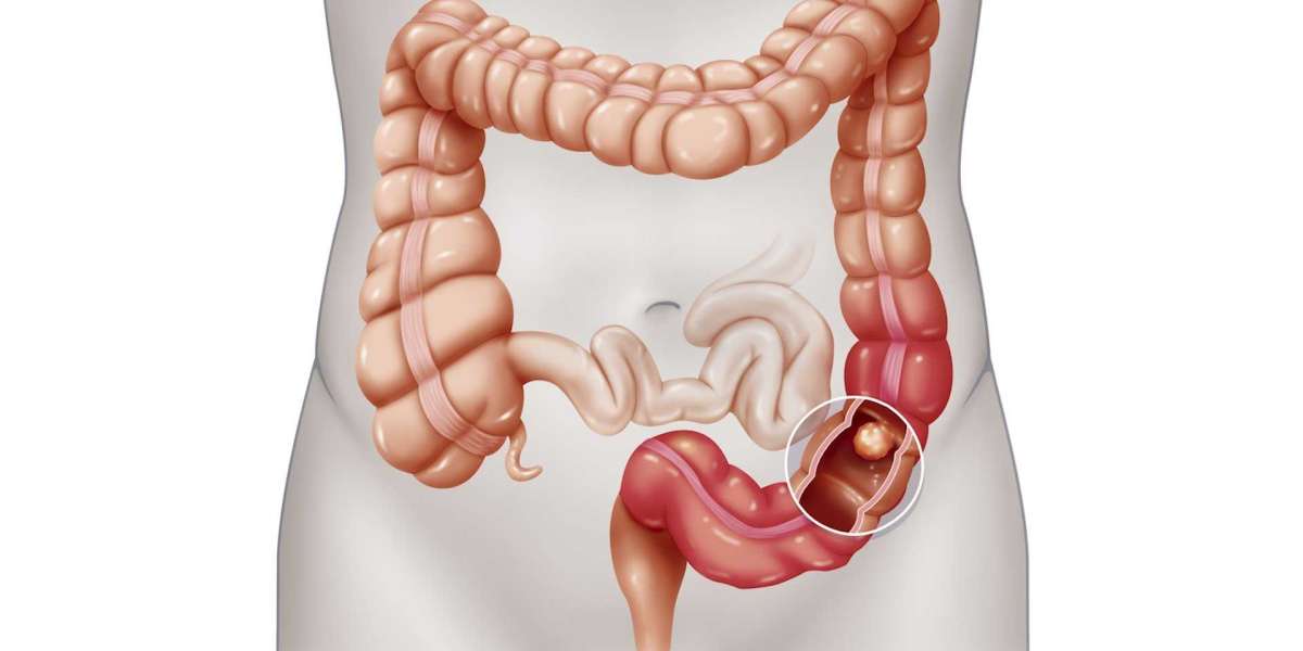 Colorectal Cancer Treatment Market Key Details and Outlook by Top Companies Till 2030